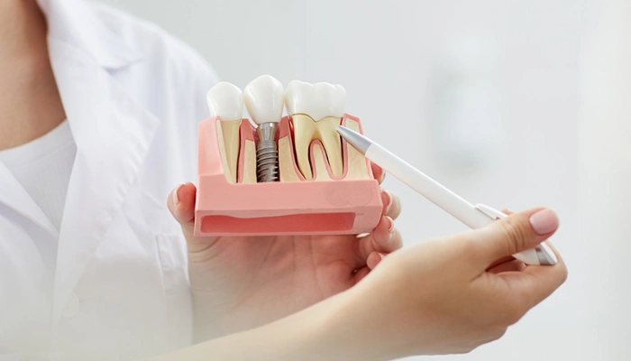 Dental Implant Marketing Strategies