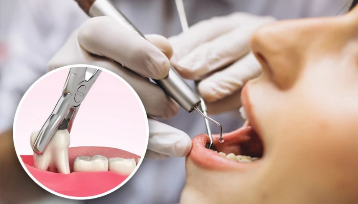 Best Practices After Tooth Extraction
