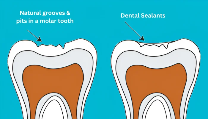Dental Sealants_ What Parents Need to Know