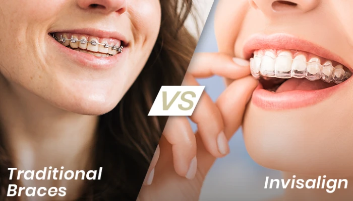 Invisalign vs Braces_ Which Is Better for You