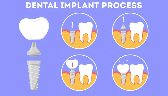 What Are Dental Implants and How Do They Work